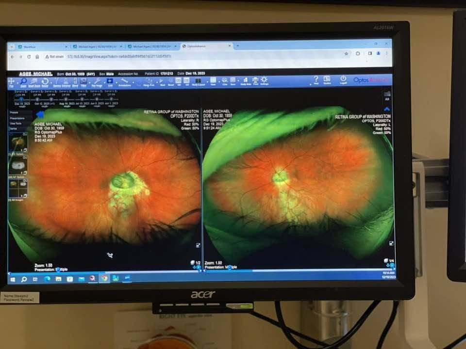 Medical retinal images of Michael's eyes displayed at Johns Hopkins